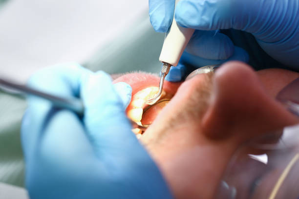 Best Emergency Tooth Extraction in Rockford, MI